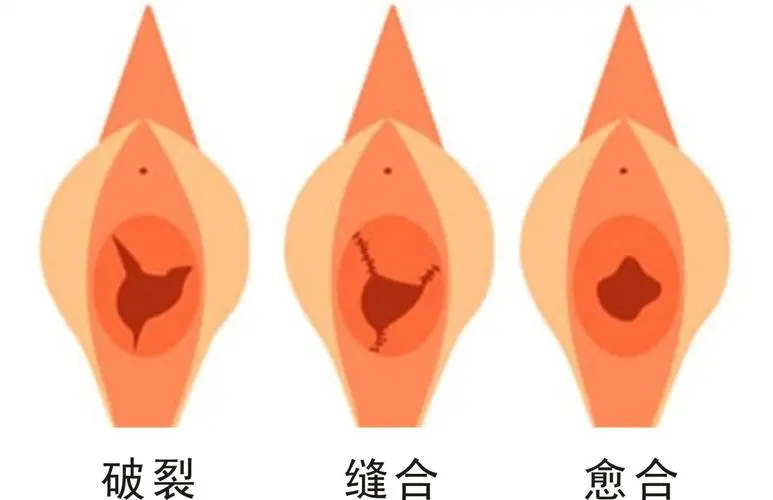 處女膜修復前后要注意事項有哪些