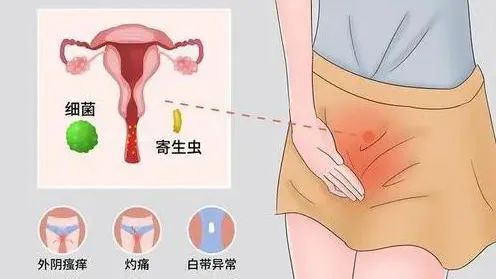 婦科炎癥.jpg